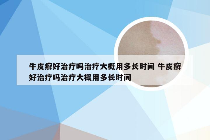 牛皮癣好治疗吗治疗大概用多长时间 牛皮癣好治疗吗治疗大概用多长时间