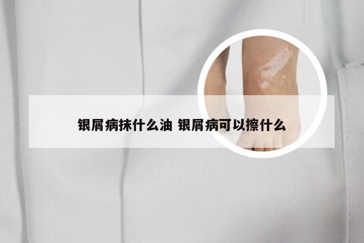 银屑病抹什么油 银屑病可以擦什么