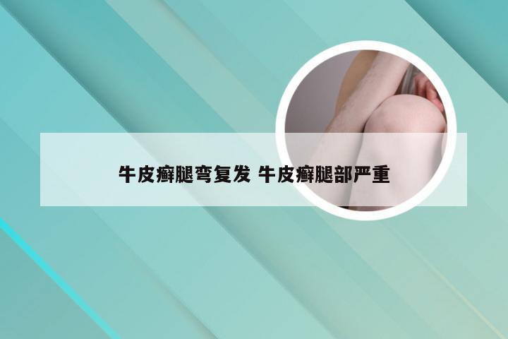 牛皮癣腿弯复发 牛皮癣腿部严重