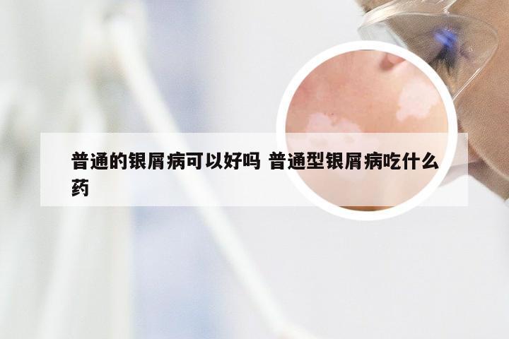 普通的银屑病可以好吗 普通型银屑病吃什么药