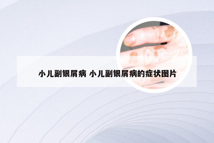 小儿副银屑病 小儿副银屑病的症状图片