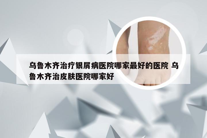 乌鲁木齐治疗银屑病医院哪家最好的医院 乌鲁木齐治皮肤医院哪家好