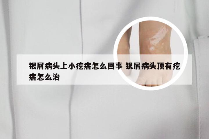 银屑病头上小疙瘩怎么回事 银屑病头顶有疙瘩怎么治