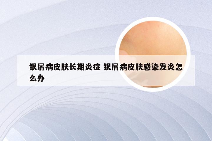 银屑病皮肤长期炎症 银屑病皮肤感染发炎怎么办