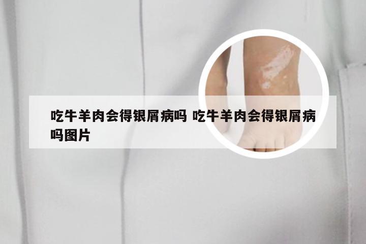 吃牛羊肉会得银屑病吗 吃牛羊肉会得银屑病吗图片