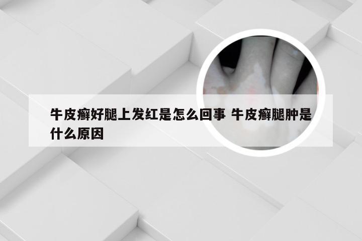 牛皮癣好腿上发红是怎么回事 牛皮癣腿肿是什么原因