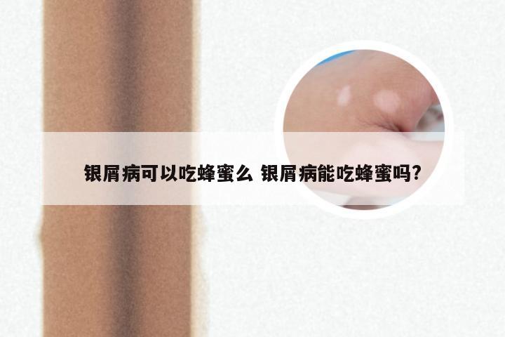 银屑病可以吃蜂蜜么 银屑病能吃蜂蜜吗?