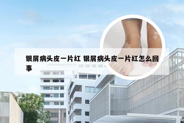 银屑病头皮一片红 银屑病头皮一片红怎么回事