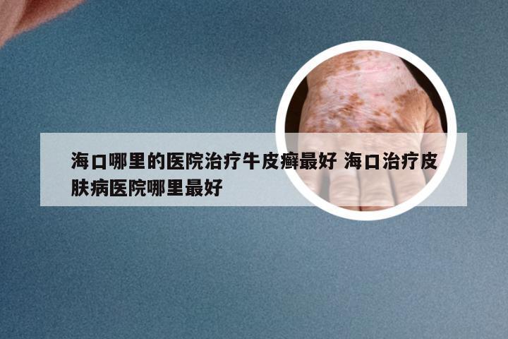 海口哪里的医院治疗牛皮癣最好 海口治疗皮肤病医院哪里最好