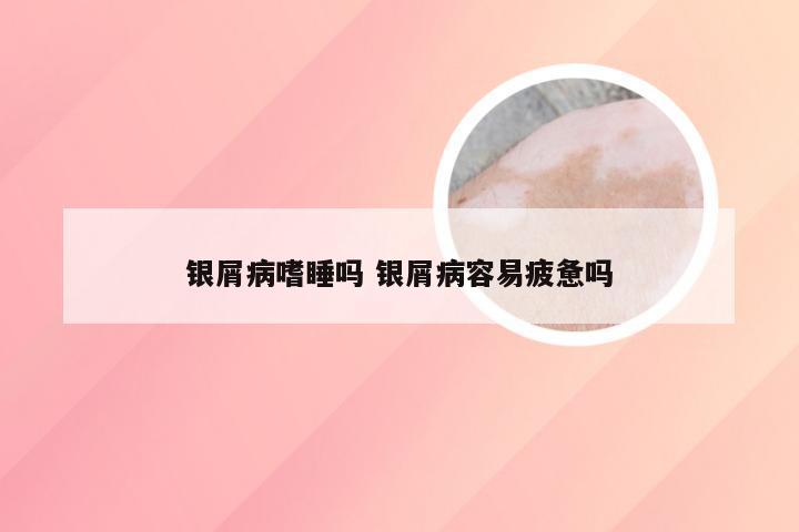 银屑病嗜睡吗 银屑病容易疲惫吗