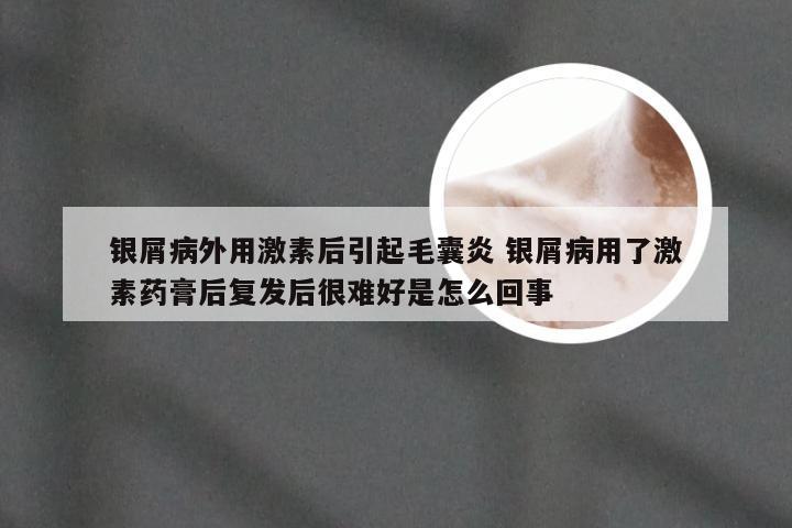 银屑病外用激素后引起毛囊炎 银屑病用了激素药膏后复发后很难好是怎么回事
