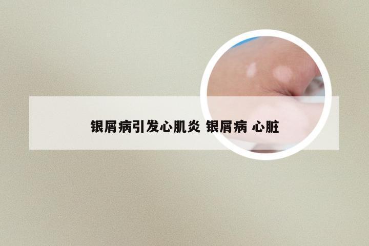 银屑病引发心肌炎 银屑病 心脏