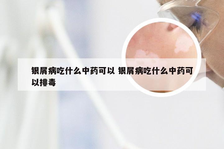 银屑病吃什么中药可以 银屑病吃什么中药可以排毒