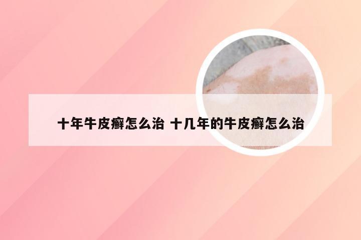 十年牛皮癣怎么治 十几年的牛皮癣怎么治