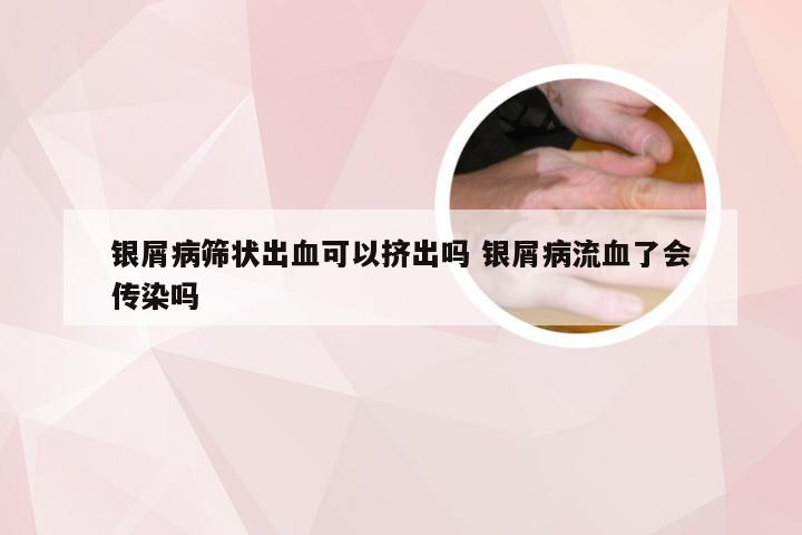 银屑病筛状出血可以挤出吗 银屑病流血了会传染吗