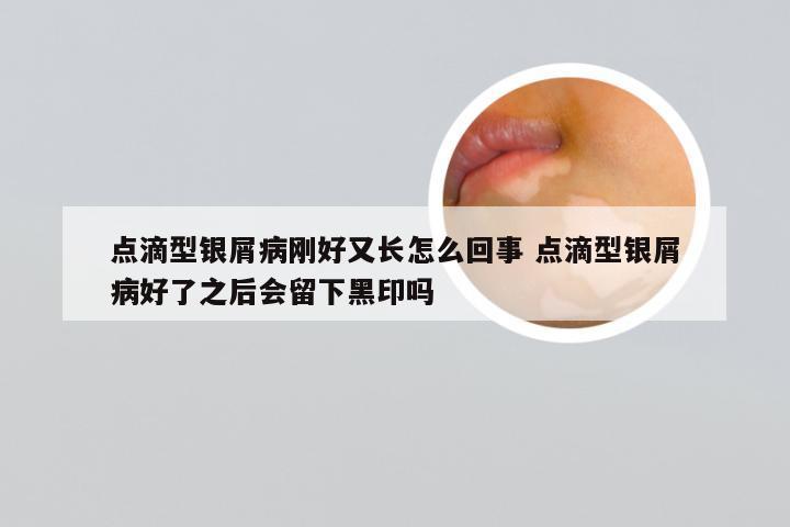 点滴型银屑病刚好又长怎么回事 点滴型银屑病好了之后会留下黑印吗