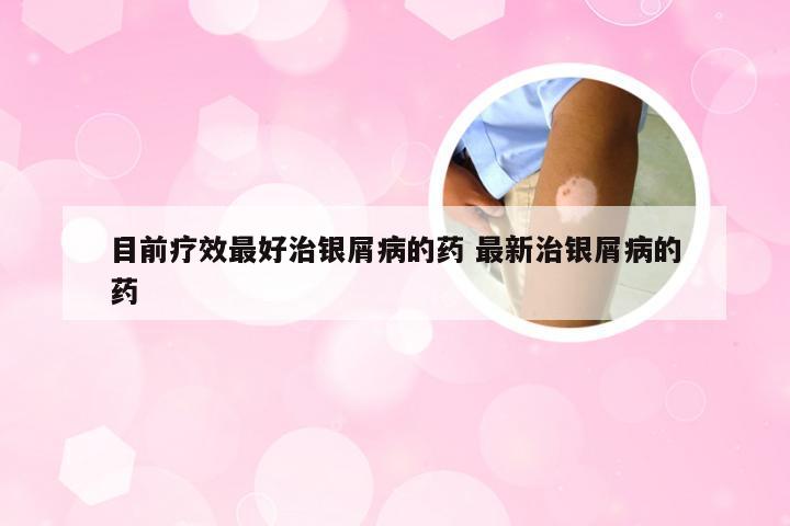 目前疗效最好治银屑病的药 最新治银屑病的药