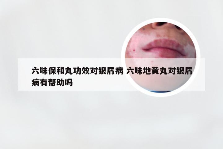六味保和丸功效对银屑病 六味地黄丸对银屑病有帮助吗