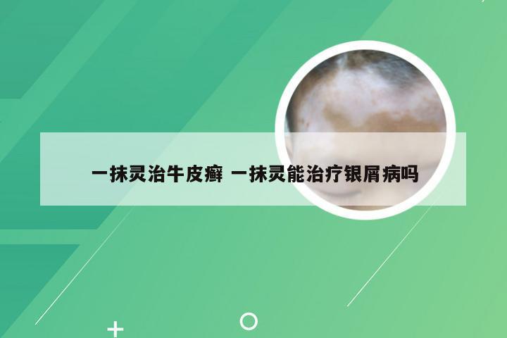 一抹灵治牛皮癣 一抹灵能治疗银屑病吗