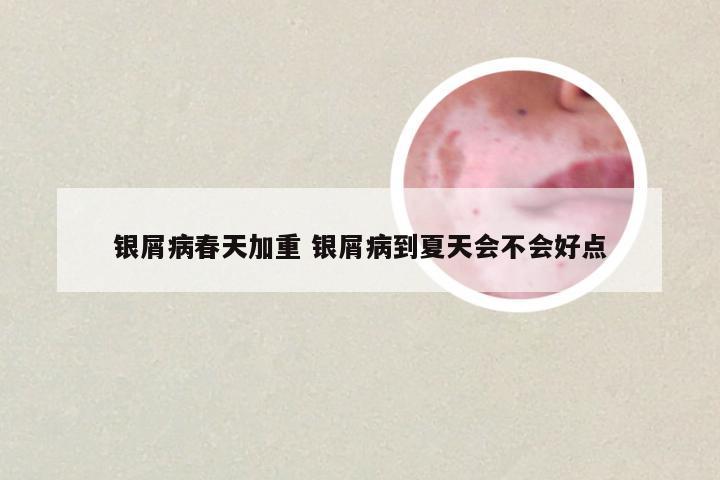 银屑病春天加重 银屑病到夏天会不会好点