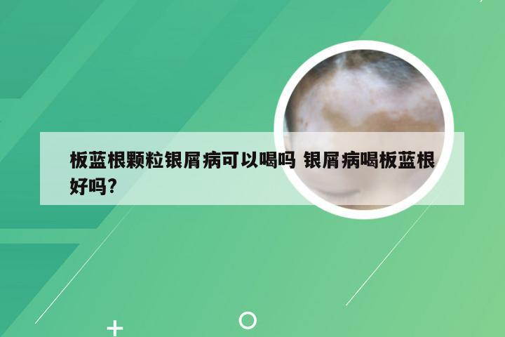板蓝根颗粒银屑病可以喝吗 银屑病喝板蓝根好吗?