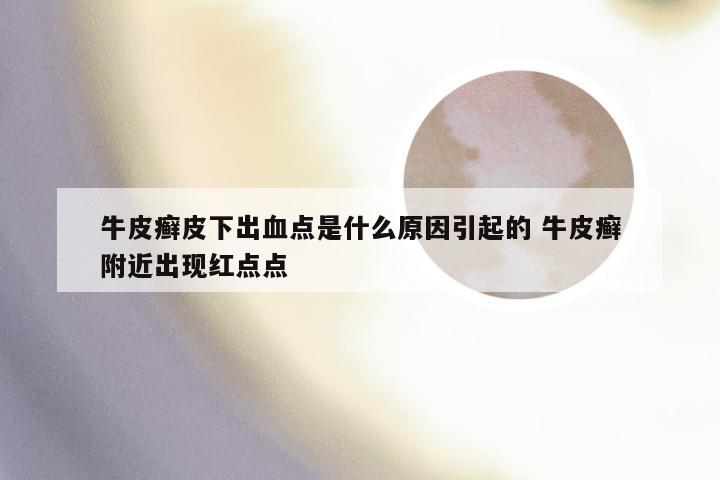 牛皮癣皮下出血点是什么原因引起的 牛皮癣附近出现红点点