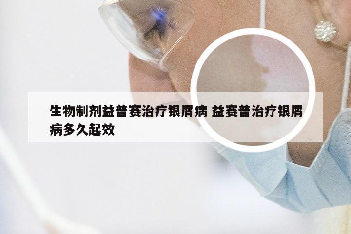 生物制剂益普赛治疗银屑病 益赛普治疗银屑病多久起效