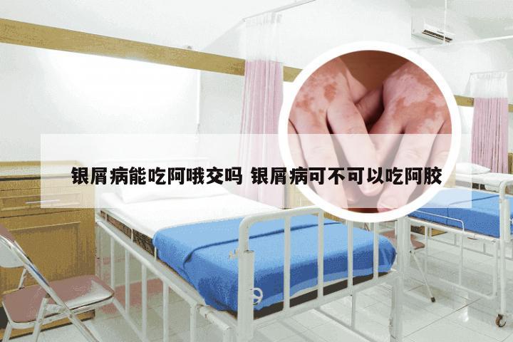 银屑病能吃阿哦交吗 银屑病可不可以吃阿胶