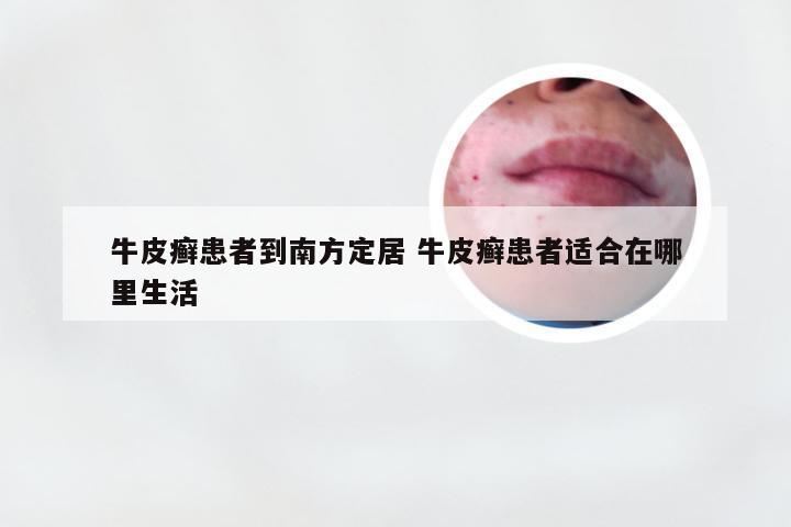 牛皮癣患者到南方定居 牛皮癣患者适合在哪里生活