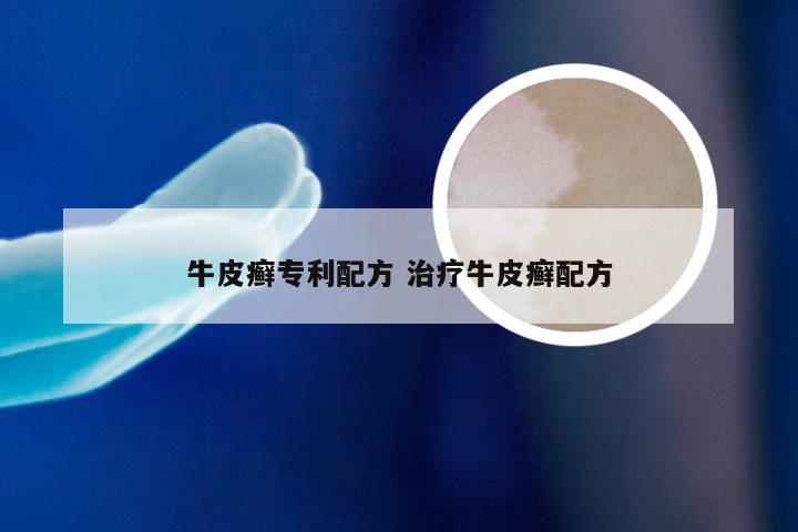牛皮癣专利配方 治疗牛皮癣配方