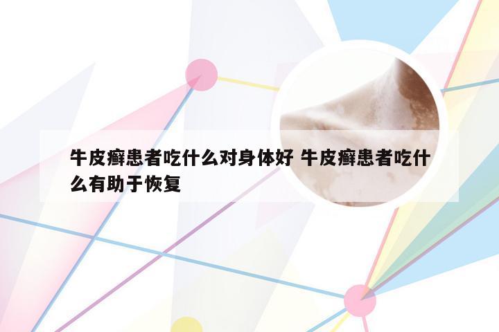 牛皮癣患者吃什么对身体好 牛皮癣患者吃什么有助于恢复