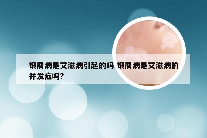 银屑病是艾滋病引起的吗 银屑病是艾滋病的并发症吗?