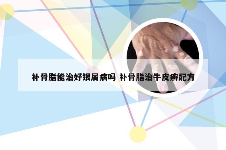补骨脂能治好银屑病吗 补骨脂治牛皮癣配方