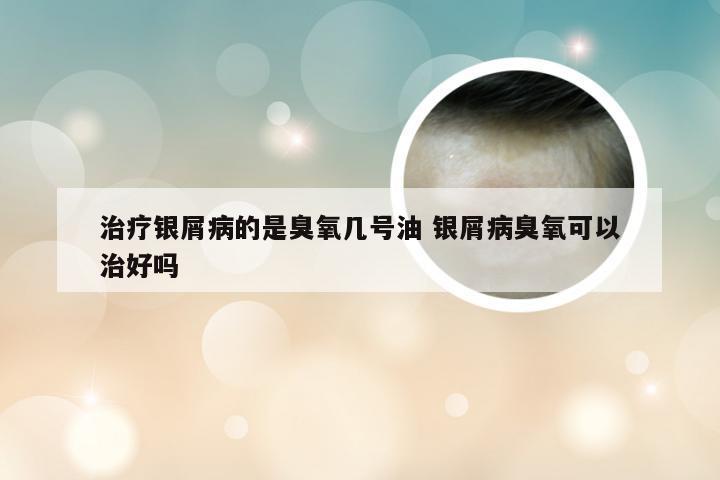 治疗银屑病的是臭氧几号油 银屑病臭氧可以治好吗