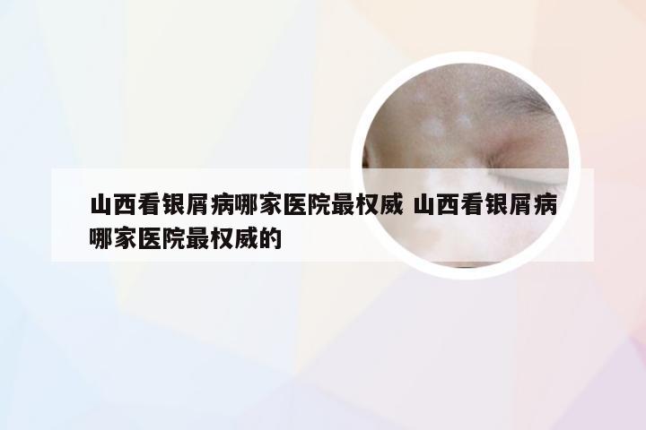 山西看银屑病哪家医院最权威 山西看银屑病哪家医院最权威的