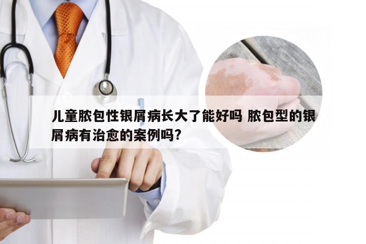 儿童脓包性银屑病长大了能好吗 脓包型的银屑病有治愈的案例吗?