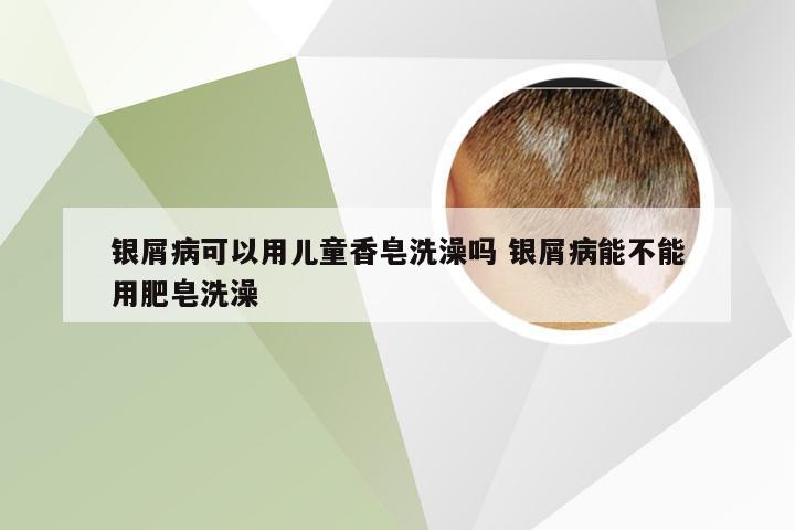 银屑病可以用儿童香皂洗澡吗 银屑病能不能用肥皂洗澡