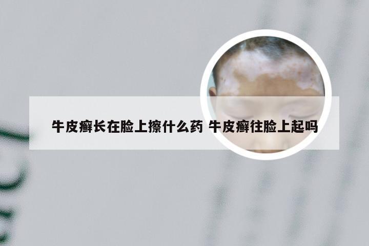 牛皮癣长在脸上擦什么药 牛皮癣往脸上起吗