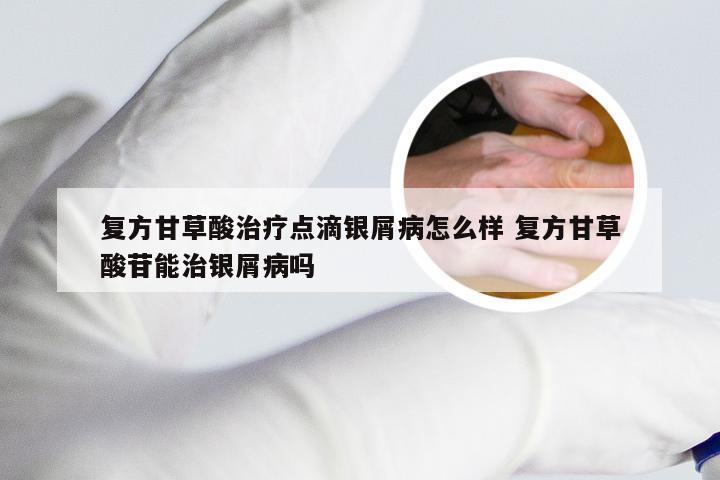 复方甘草酸治疗点滴银屑病怎么样 复方甘草酸苷能治银屑病吗