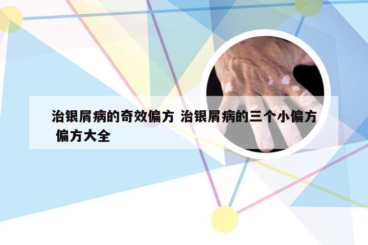 治银屑病的奇效偏方 治银屑病的三个小偏方 偏方大全