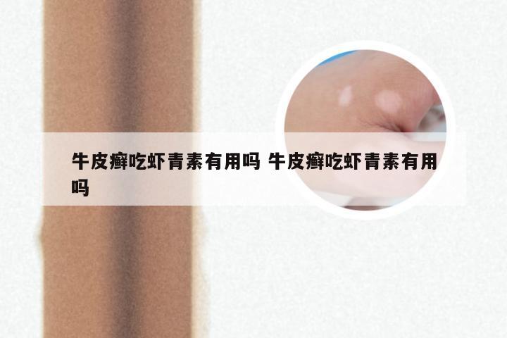 牛皮癣吃虾青素有用吗 牛皮癣吃虾青素有用吗