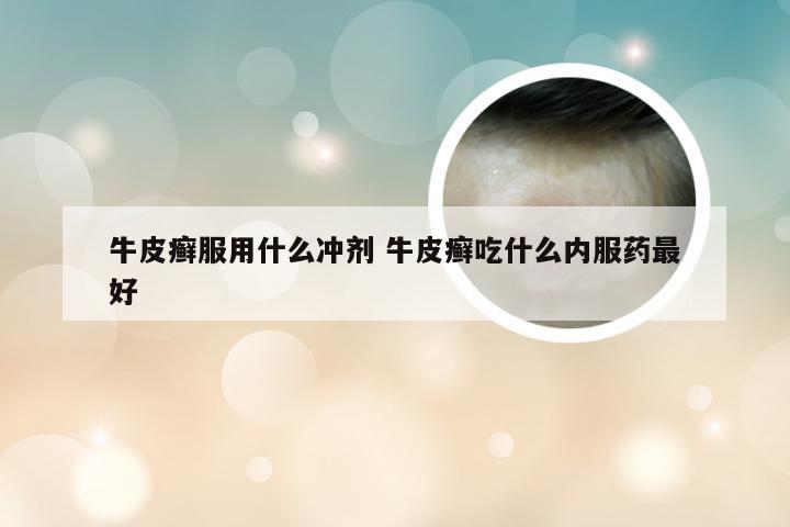 牛皮癣服用什么冲剂 牛皮癣吃什么内服药最好
