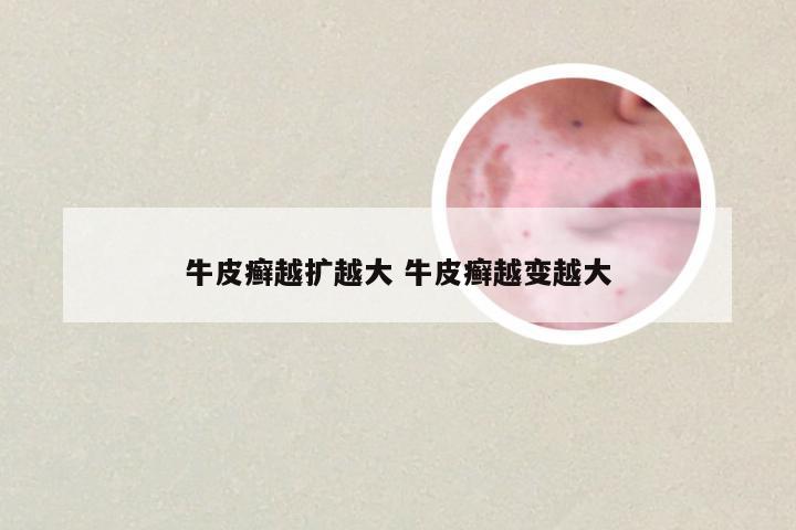 牛皮癣越扩越大 牛皮癣越变越大