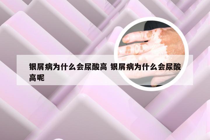 银屑病为什么会尿酸高 银屑病为什么会尿酸高呢