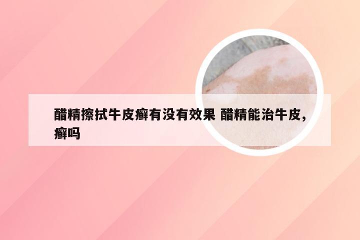 醋精擦拭牛皮癣有没有效果 醋精能治牛皮,癣吗