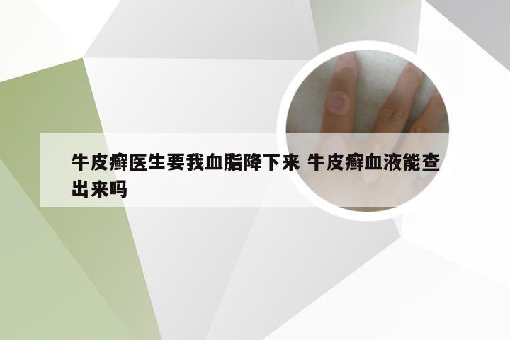 牛皮癣医生要我血脂降下来 牛皮癣血液能查出来吗