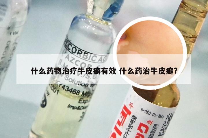 什么药物治疗牛皮癣有效 什么药治牛皮癣?