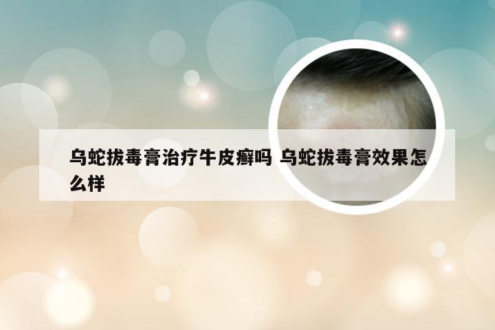 乌蛇拔毒膏治疗牛皮癣吗 乌蛇拔毒膏效果怎么样