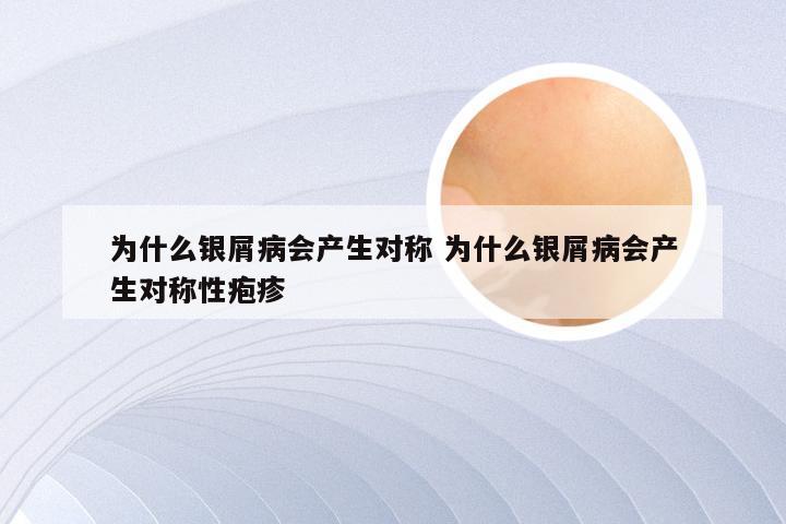 为什么银屑病会产生对称 为什么银屑病会产生对称性疱疹