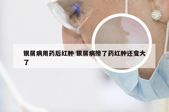 银屑病用药后红肿 银屑病擦了药红肿还变大了